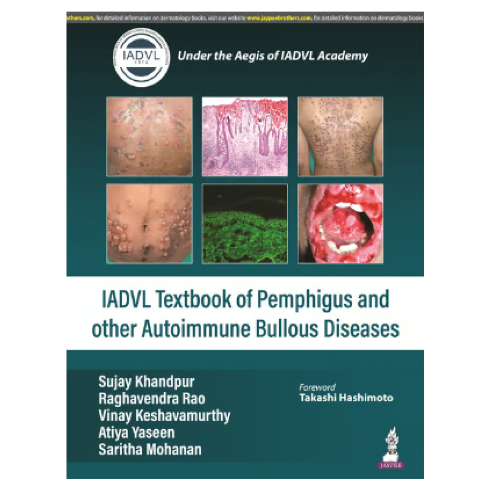 IADVL Textbook of Pemphigus and Other Autoimmune Bullous Diseases;1st Edition 2024 By Sujay Khandpur