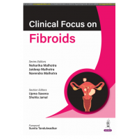 Clinical Focus on Fibroids;1st Edition 2025 by Neharika Malhotra, Jaideep Malhotra & Narendra Malhotra