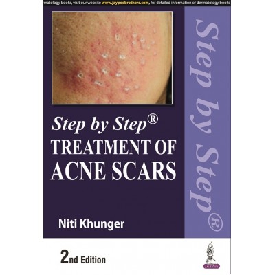 Step By Step Treatment Of Acne Scars; 2nd Edition 2022 by Niti Khunger